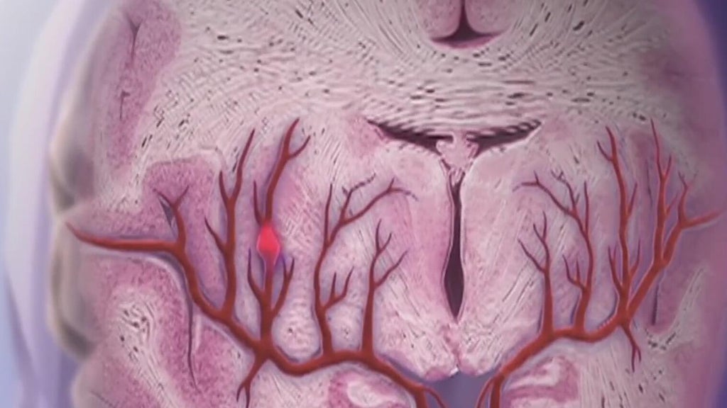 Knowing the signs of a stroke can save lives — Decatur Community news